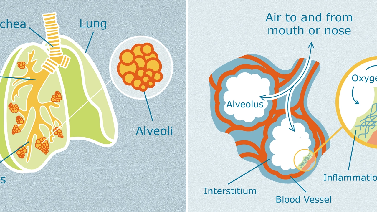 The Role of Oxygen Therapy in Managing Idiopathic Pulmonary Fibrosis